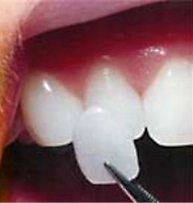 Porcelain veneers are thin wafers of porcelain bonded onto a tooth.