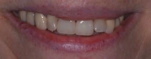 Donna's smile after receiving porcelain veneers on her two front teeth.