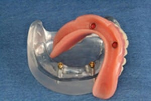 Snap-on dentures are an example of affordable dental implants.