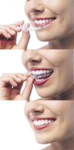 How invisalign works